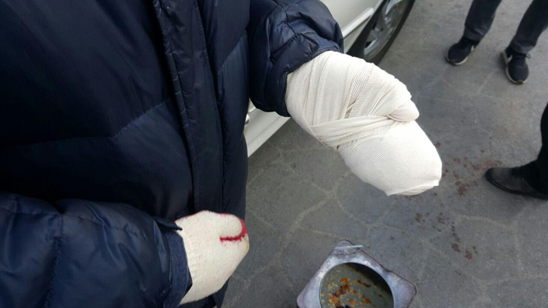 지난해 11월 2차 강제집행 과정에서 궁중족발 사장 김씨는 손을 크게 다쳤다.
