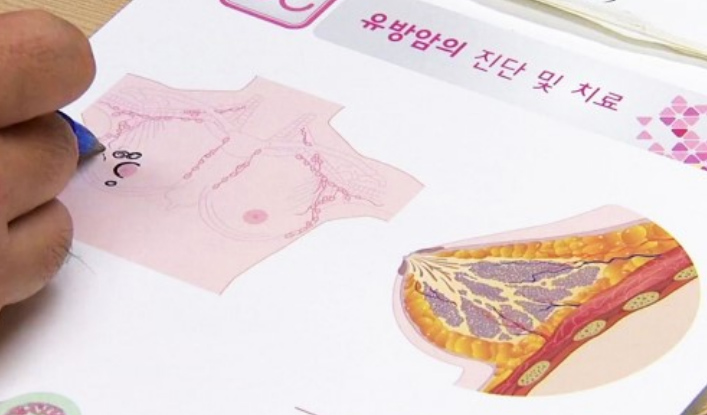 유방암(자료사진)